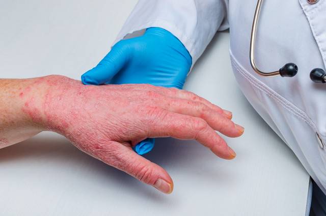 is-psoriasis-an-infectious-disease-know-about-its-symptoms-and-treatments- صورة المقال